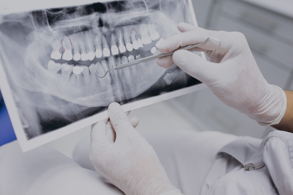 esjident_servicio-endodoncia
