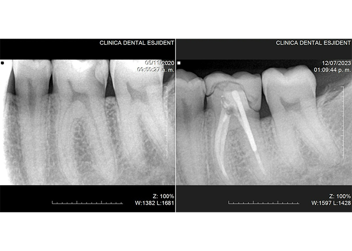 esjident_servicio-endodoncia