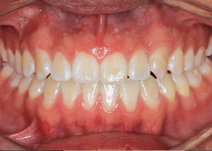 esjident_servicio-real-ortodoncia-caso-1-2