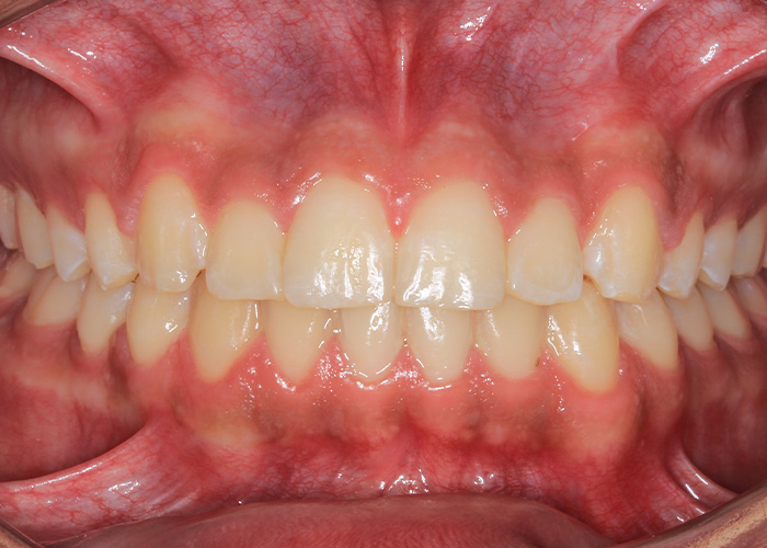 esjident_servicio-real-ortodoncia-caso-2