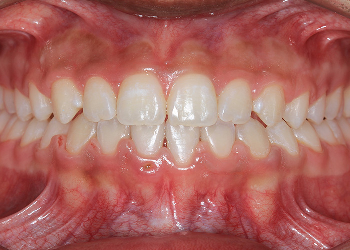esjident_servicio-real-ortodoncia-caso-3-1
