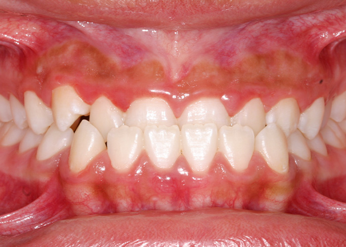 esjident_servicio-real-ortodoncia-caso-3