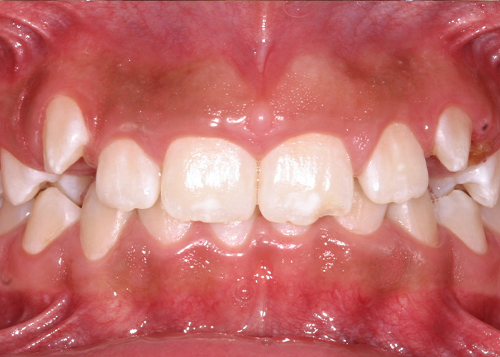 esjident_servicio-real-ortodoncia-caso-4